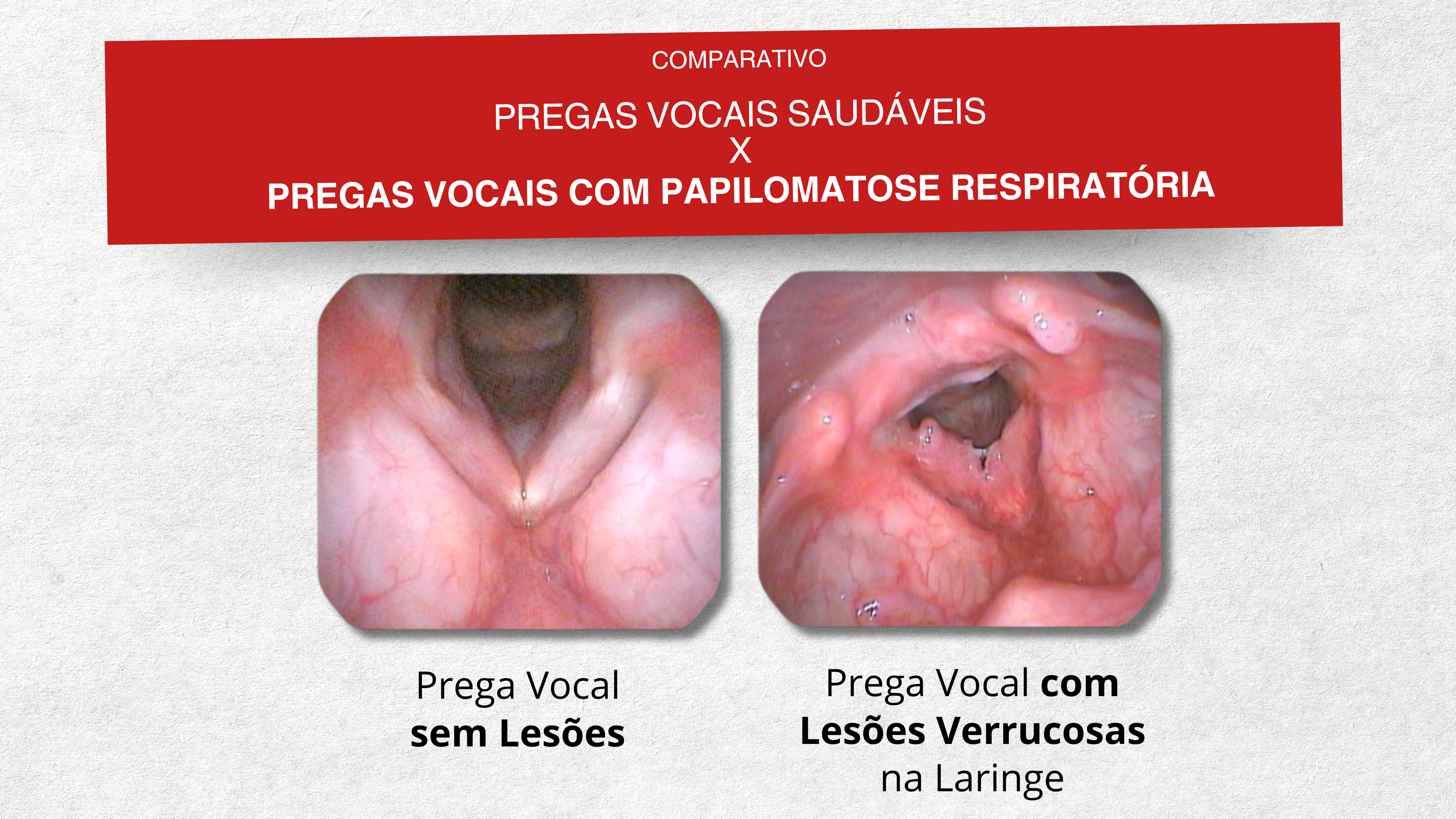Pregas vicais com papilomatose respirátoria